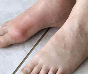 Cậu bé 13 tuổi mắc bệnh gout, nguyên nhân đến từ thức uống mà hầu hết đứa trẻ nào cũng ưa thích.